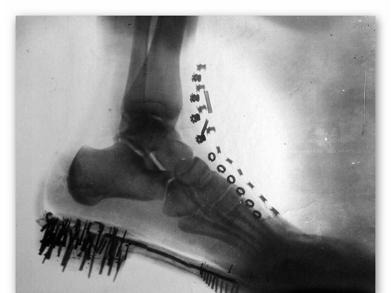Рентгеновский снимок ноги Теслы